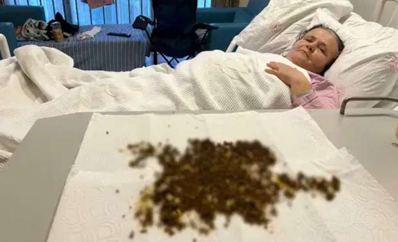 Böylesi görülmedi: Safra kesesinden 20 bin taş çıkarıldı!