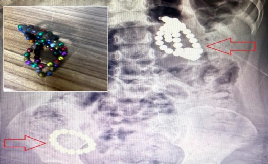 Doktorları şoke eden olay: 3 yaşındaki çocuğun midesinden 66 mıknatıs çıktı!