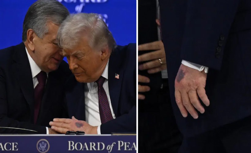 Trump'ın elindeki morluğun nedeni belli oldu