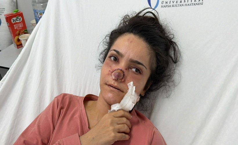 Eşi burnunu ısırarak koparmıştı... Deşhet anlarını anlattı
