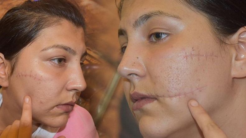 Mahkeme heyetinin kadın üyeleri, salonu boşaltıp Perkgün’ün yara izlerini inceledi