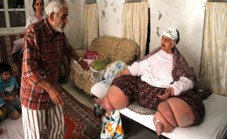 Fil hastalığı yüzünden 9 yıldır gün ışığı görmedi
