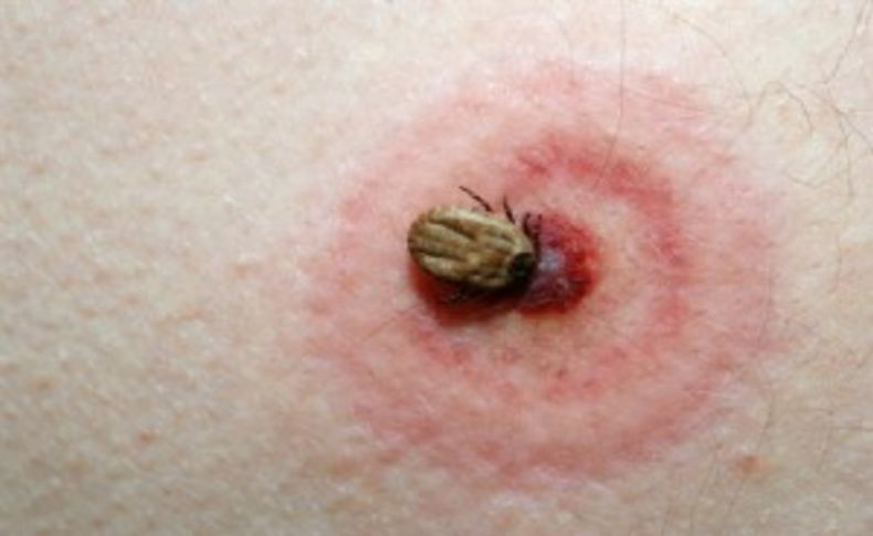 Lyme hastalığına dikkat